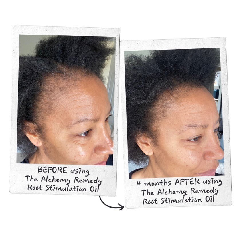 How Does Hair Grow? Root Stimulation Oil Success Stories