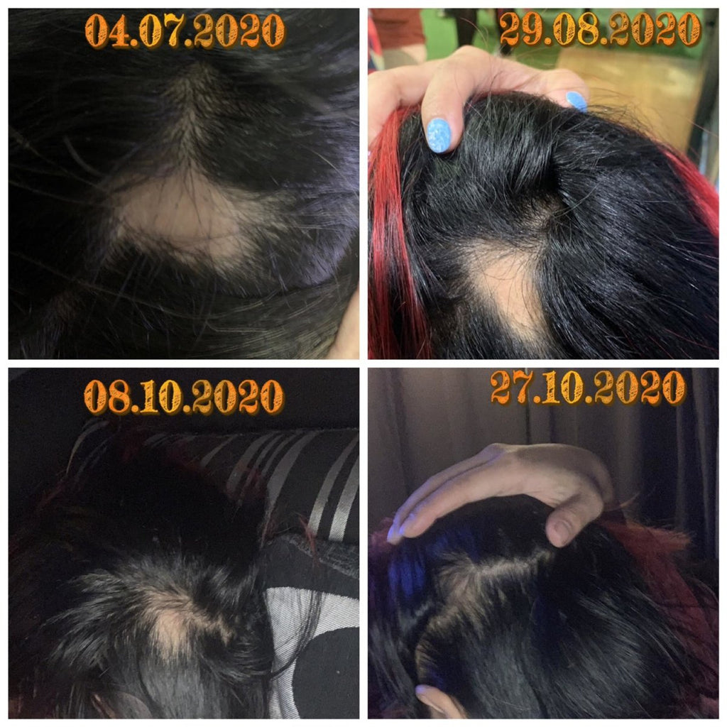 Let's Talk About Hair Loss
